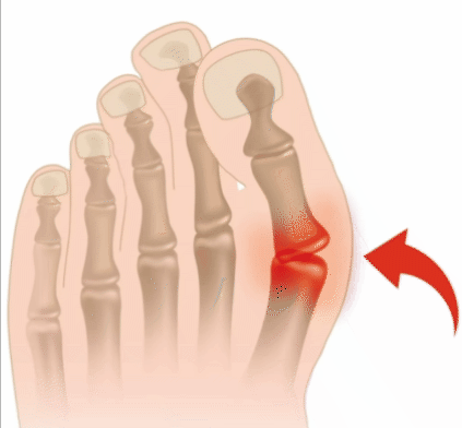 Joanete — Hallux Valgus